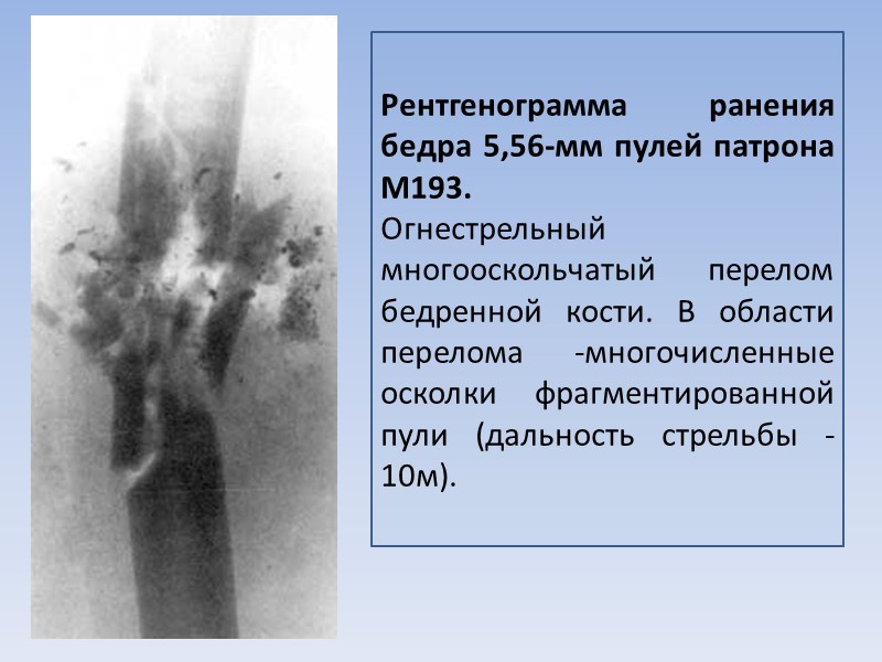 Рентгенограмма ранения бедра 5,56-мм пулей патрона М193.  Огнестрельный многооскольчатый перелом бедренной кости. В
